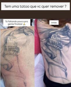 remoção-de-tatuagem-nas-costas-Maria-Menina-Clínica-de-Estética