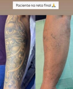 remoção-de-tatuagem-no-braço-Maria-Menina-Clínica-de-Estética