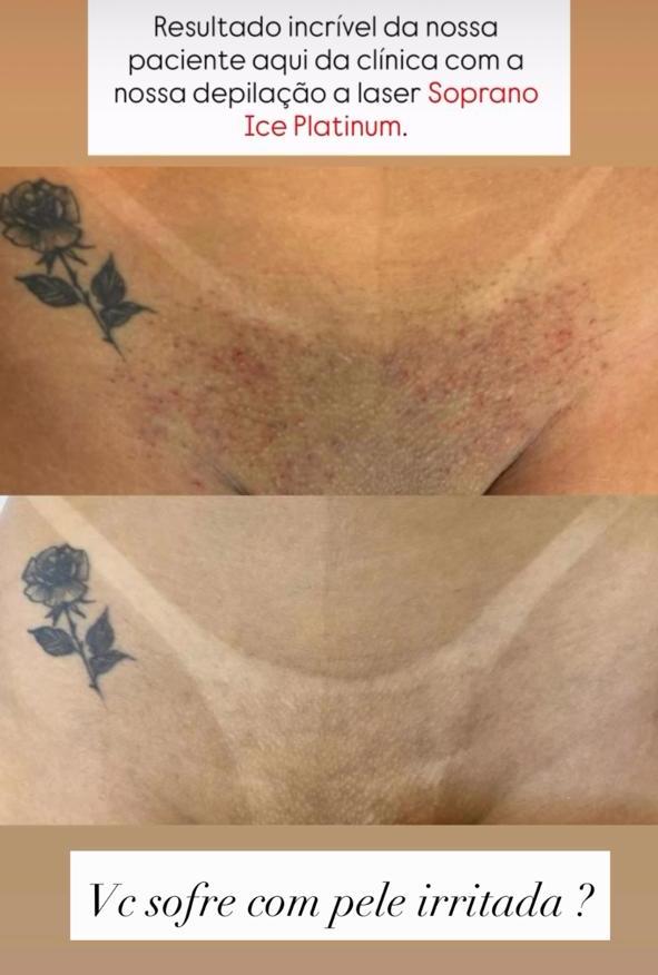 Depilação a Laser na Virilha