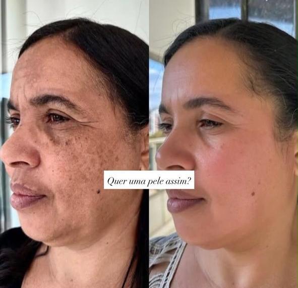 Rejuvenescimento Facial - Maria Menina Clínica Estética