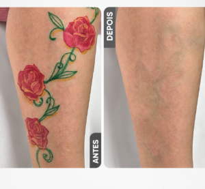 Antes-e-Depois-da-Remoção-de-Tatuagem-Colorida
